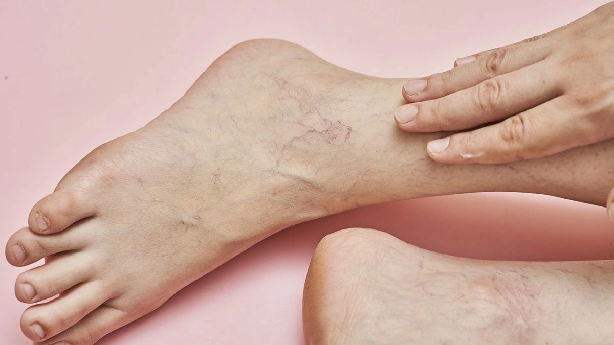 Варикоз: причины, симптомы и современные методы лечения